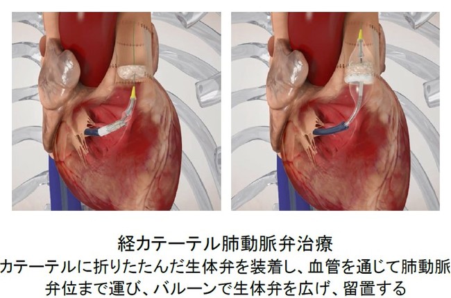 {̌oJe[exَÁi@\sSɊׂ̕ق̒ujAGh[Y̌oJe[e̕قAVS̊҂̊Jp񐔂炷\ɍv